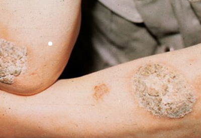 真菌感染会导致皮肤越来越硬是怎么回事